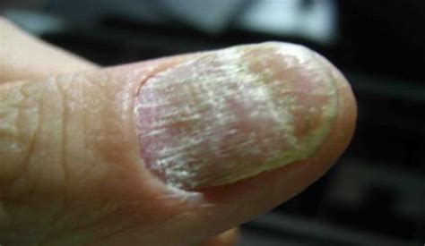 灰指甲的症状图片,灰指甲图片大全_灰指甲_39疾病百科
