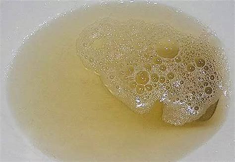泡沫尿是否等于蛋白尿？泡沫越多说明蛋白尿越严重吗？