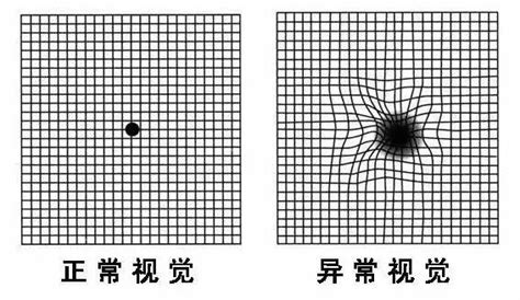 视野缺损自测图图片