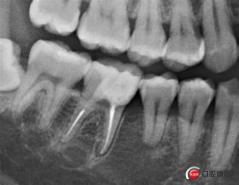 磨牙根管治疗后冠延长+全瓷高嵌体修复-罗俊的博客-KQ88口腔博客