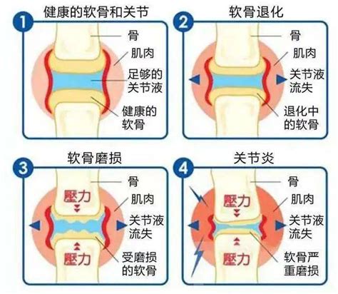 骨性关节炎的手术治疗策略，都在这篇课件里！ - 好医术早读文章 - 好医术-赋能医生守护生命