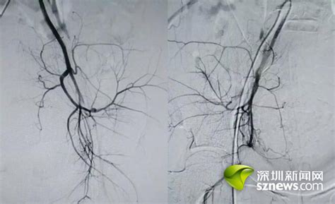 3D医学：子宫肌瘤动脉栓塞术的过程_腾讯视频