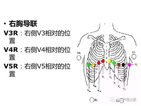 心电图连接示意图图片