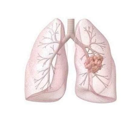 肺癌早期都有哪些症状_肿瘤_医生在线