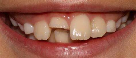 成年人门牙因某些原因导致缺失该怎么办？如何修复缺失的门牙？ - 知乎