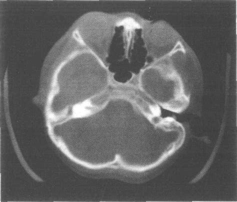 4 骨性外耳道闭锁-CT诊断-医学