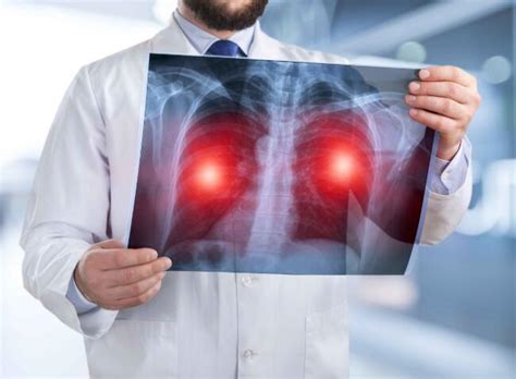 肺癌早期，除了咳嗽，这几个症状虽隐蔽却不难发现，注意观察_凤凰网