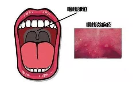 腭咽弓发炎图片