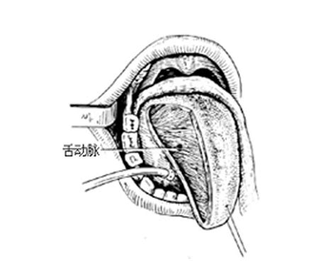 13.舌系带修整术-口腔颌面外科手术与手术技巧-医学