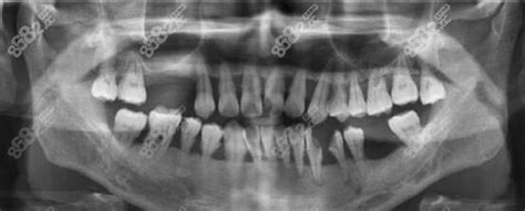 如何判断自己得了牙周炎?你看过牙周病的图片吗?,专家提醒-8682赴 ...