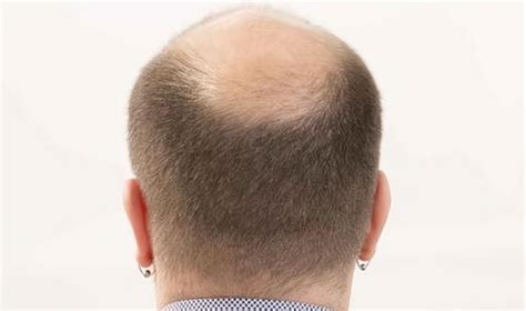 为什么科学家公认“阉割”能解决中年秃顶?|秃顶|雄性|激素_新浪新闻