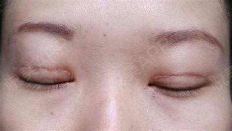 上眼皮是全身最不容易长疤的部位，为什么做完双眼皮以后有 ...