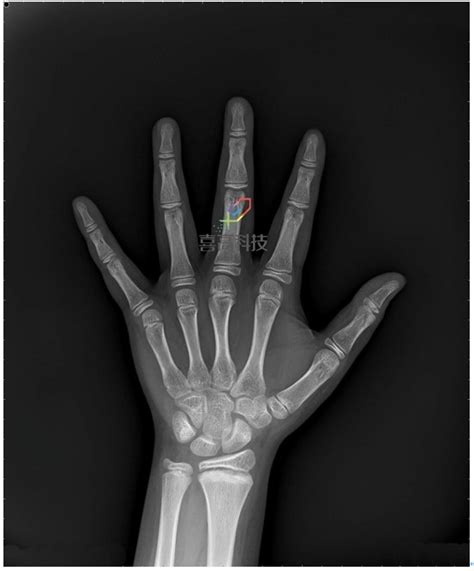 骨龄鉴定_骨龄测评_人工智能骨龄软件—喜高科技公司