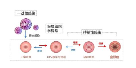 HPV52阳性是丈夫传染的吗-有来医生
