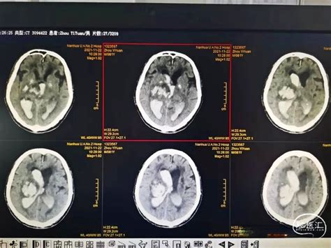 一例大量脑出血的内镜治疗 | 颅脑创伤-神经重症病例周刊（137期） - 脑医汇 - 神外资讯 - 神介资讯
