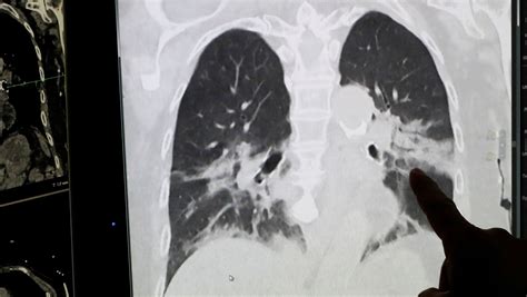 华媒：一名新冠肺炎终末期患者成功接受肺移植 - 2020年5月12日, 俄罗斯卫星通讯社