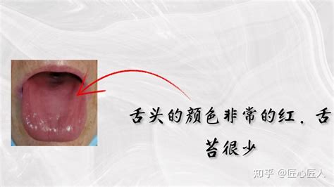 阴虚舌苔图片