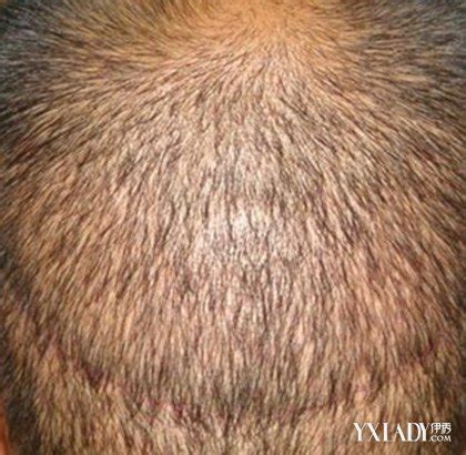 【图】遗传性脱发的原因有哪些 脱发的4大原因及治疗方法(2)_伊秀美容网|yxlady.com