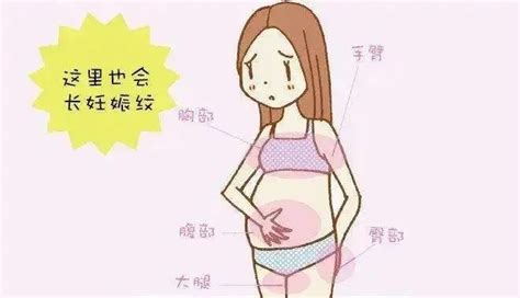 妊娠纹的产生与预防_珠海禅诚医院【官网】