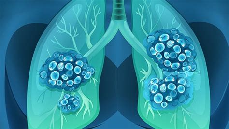 传染性非典型肺炎的传播途径是什么？有这4种传播途径-肺炎传染-复禾健康