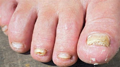 几大类型灰指甲的症状-灰指甲症状-复禾健康