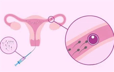 供精人工授精的流程（三代供卵试管助孕机构）-助韵传承辅助生殖中心