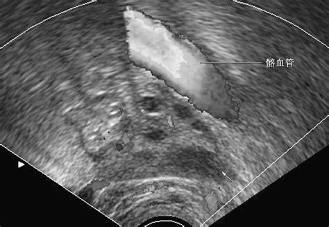 病例3 正常卵巢(黄体早期)-妇产科学-医学