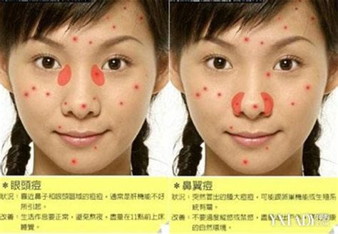 那些医生都是怎么改善脸上痘痘、痘印的? 正确的祛痘方法是什么? - 知乎