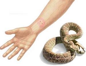 毒蛇咬伤 - 医学百科