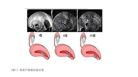 瘢痕子宫图片