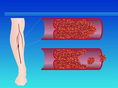 下肢深静脉血栓形成（DVT)的病因分析及治疗|静脉血栓的病因,下肢静脉血栓治疗
