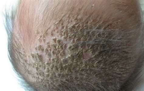 头部脂溢性皮炎是什么样子：原因症状和治疗方法-中华银屑病网