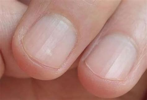 指甲有竖纹，是身体出问题了吗？|疾病|银屑病|新冠肺炎_新浪新闻