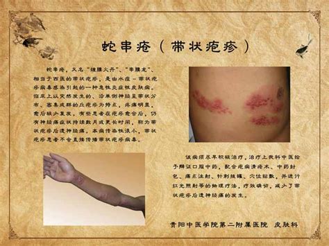 蛇串疮图片
