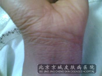汗孔角化症图片