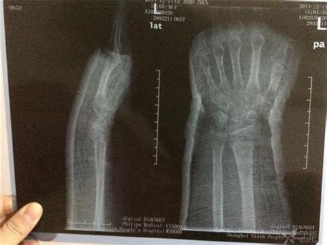 男孩左手腕骨折被医生包扎右手_第二人生
