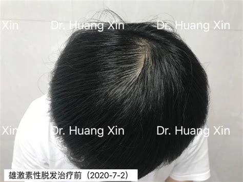 雄激素性脱发|脱发人士必看：拯救发量的N个办法，到底哪个最靠谱？ 疫苗|新冠|接种|剂次