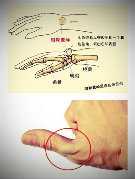 虎口腱鞘囊肿图片