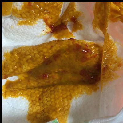 果酱样大便图片