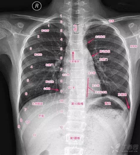正常胸肺ct图片图解