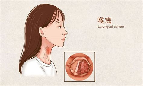 喉炎的症状图片-喉炎图片大全-喉炎-39疾病百科
