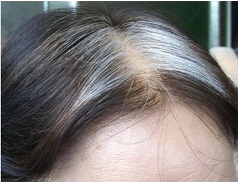 血热白发吃什么可以7天白发变黑、10年不反弹？
