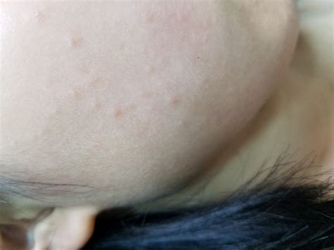 皮肤过敏起红疹怎么办？