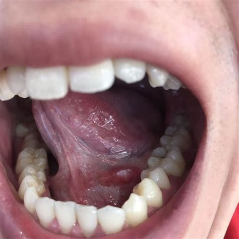 舌中心舌苔发黑(图片) - 专家文章 - 复禾健康