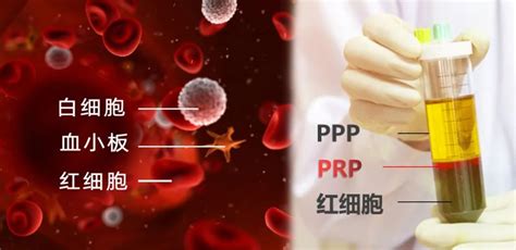 富血小板血浆（Platelet-Rich Plasma，PRP）治疗术-湖北省第三人民医院