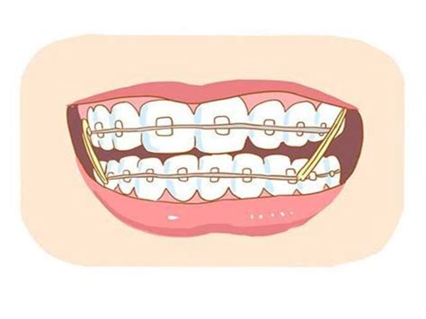 关于「牙齿矫正」牙科医生老王想跟你说的3件事 - 知乎