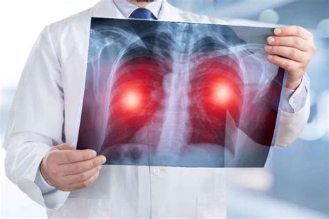 周围型肺癌常见的组织类型是什么？_杏林普康