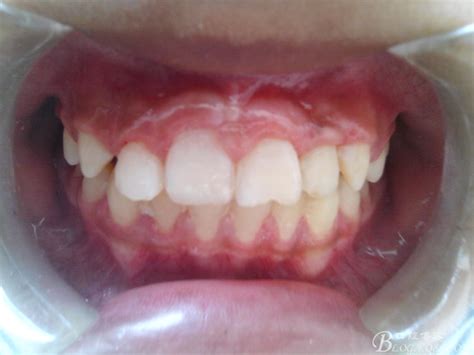 牙根处为什么会烂？ 牙齿根部烂了怎么办？|牙根|为什么-知识百科-川北在线