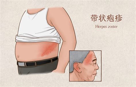 警惕特殊类型老年带状疱疹--姜堰日报