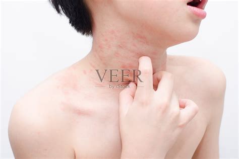 患有皮疹的儿童皮肤照片摄影图片_ID:307625532-Veer图库